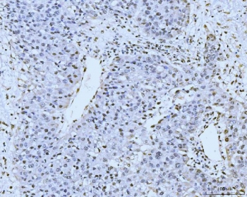 IHC staining of FFPE human liver cancer tissue with KIFC1 antibody. HIER: boil tissue sections in pH8 EDTA for 20 min and allow to cool before testing.