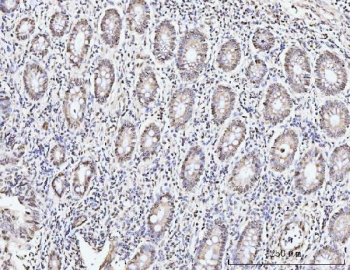 IHC staining of FFPE human gastric adenocarcinoma tissue with KIFC1 antibody. HIER: boil tissue sections in pH8 EDTA for 20 min and allow to cool before testing.