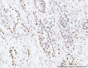 IHC staining of FFPE human appendiceal adenocarcinoma tissue with KIFC1 antibody. HIER: boil tissue sections in pH8 EDTA for 20 min and allow to cool before testing.