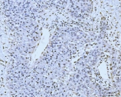 IHC staining of FFPE human liver cancer tissue with KIFC1 antibody. HIER: boil tissue sections in pH8 EDTA for 20 min and allow to cool before testing.