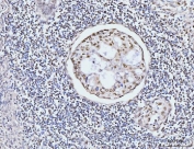 IHC staining of FFPE human gastric adenocarcinoma tissue with KIFC1 antibody. HIER: boil tissue sections in pH8 EDTA for 20 min and allow to cool before testing.