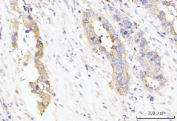IHC staining of FFPE human appendiceal adenocarcinoma tissue with LARP4B antibody. HIER: boil tissue sections in pH8 EDTA for 20 min and allow to cool before testing.