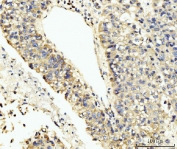 IHC staining of FFPE human liver cancer tissue with LARP4B antibody. HIER: boil tissue sections in pH8 EDTA for 20 min and allow to cool before testing.