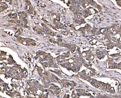 IHC staining of FFPE human breast cancer tissue with LSR antibody. HIER: boil tissue sections in pH8 EDTA for 20 min and allow to cool before testing.