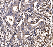IHC staining of FFPE human liver cancer tissue with LSR antibody. HIER: boil tissue sections in pH8 EDTA for 20 min and allow to cool before testing.