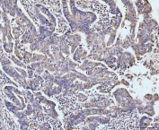 IHC staining of FFPE human colonic adenocarcinoma tissue with HPK1 antibody. HIER: boil tissue sections in pH8 EDTA for 20 min and allow to cool before testing.