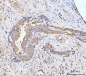 IHC staining of FFPE human gall bladder adenosquamous carcinoma tissue with HPK1 antibody. HIER: boil tissue sections in pH8 EDTA for 20 min and allow to cool before testing.