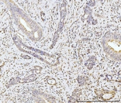 IHC staining of FFPE human gall bladder adenosquamous carcinoma tissue with MOV10 antibody. HIER: boil tissue sections in pH8 EDTA for 20 min and allow to cool before testing.