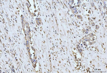 IHC staining of FFPE human appendiceal adenocarcinoma tissue with MOV10 antibody. HIER: boil tissue sections in pH8 EDTA for 20 min and allow to cool before testing.