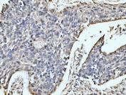 IHC staining of FFPE human esophageal squamous carcinoma tissue with MOV10 antibody. HIER: boil tissue sections in pH8 EDTA for 20 min and allow to cool before testing.