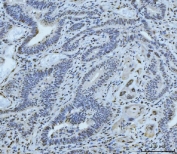 IHC staining of FFPE human gall bladder adenosquamous carcinoma tissue with Meiotic recombination 11 antibody. HIER: boil tissue sections in pH8 EDTA for 20 min and allow to cool before testing.