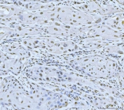 IHC staining of FFPE human gall bladder adenosquamous carcinoma tissue with Meiotic recombination 11 antibody. HIER: boil tissue sections in pH8 EDTA for 20 min and allow to cool before testing.