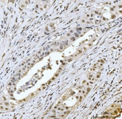IHC staining of FFPE human appendiceal adenocarcinoma tissue with Meiotic recombination 11 antibody. HIER: boil tissue sections in pH8 EDTA for 20 min and allow to cool before testing.