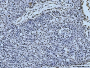 IHC staining of FFPE human colonic adenocarcinoma tissue with Meiotic recombination 11 antibody. HIER: boil tissue sections in pH8 EDTA for 20 min and allow to cool before testing.
