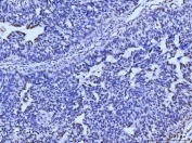 IHC staining of FFPE human bladder epithelial carcinoma tissue with Meiotic recombination 11 antibody. HIER: boil tissue sections in pH8 EDTA for 20 min and allow to cool before testing.