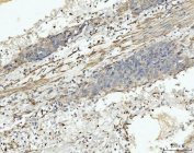 IHC staining of FFPE human liver cancer tissue with MT-ND5 antibody. HIER: boil tissue sections in pH8 EDTA for 20 min and allow to cool before testing.