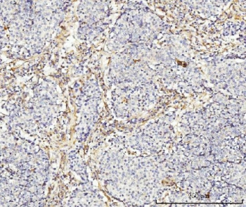 IHC staining of FFPE human lung cancer tissue with MT-ND5 antibody. HIER: boil tissue sections in pH8 EDTA for 20 min and allow to cool before testing.