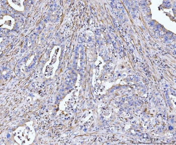 IHC staining of FFPE human appendiceal adenocarcinoma tissue with MT-ND5 antibody. HIER: boil tissue sections in pH8 EDTA for 20 min and allow to cool before testing.