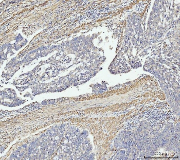 IHC staining of FFPE human colonic adenocarcinoma tissue with MT-ND5 antibody. HIER: boil tissue sections in pH8 EDTA for 20 min and allow to cool before testing.