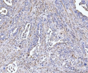IHC staining of FFPE human appendiceal adenocarcinoma tissue with MT-ND5 antibody. HIER: boil tissue sections in pH8 EDTA for 20 min and allow to cool before testing.
