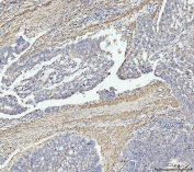 IHC staining of FFPE human colonic adenocarcinoma tissue with MT-ND5 antibody. HIER: boil tissue sections in pH8 EDTA for 20 min and allow to cool before testing.