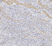 IHC staining of FFPE human gastric cancer tissue with MT-ND5 antibody. HIER: boil tissue sections in pH8 EDTA for 20 min and allow to cool before testing.