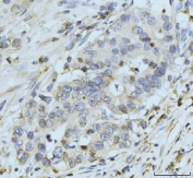IHC staining of FFPE human appendiceal adenocarcinoma tissue with NUP210 antibody. HIER: boil tissue sections in pH8 EDTA for 20 min and allow to cool before testing.