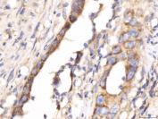 IHC staining of FFPE human colorectal cancer tissue with Myomegalin antibody. HIER: boil tissue sections in pH8 EDTA for 20 min and allow to cool before testing.