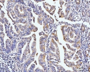 IHC staining of FFPE human gastric adenocarcinoma tissue with PDLIM7 antibody. HIER: boil tissue sections in pH8 EDTA for 20 min and allow to cool before testing.