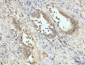 IHC staining of FFPE human appendiceal adenocarcinoma tissue with PDLIM7 antibody. HIER: boil tissue sections in pH8 EDTA for 20 min and allow to cool before testing.