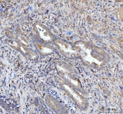 IHC staining of FFPE human gall bladder adenosquamous carcinoma tissue with PDLIM7 antibody. HIER: boil tissue sections in pH8 EDTA for 20 min and allow to cool before testing.
