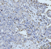 IHC staining of FFPE human appendiceal adenocarcinoma tissue with PLD3 antibody. HIER: boil tissue sections in pH8 EDTA for 20 min and allow to cool before testing.