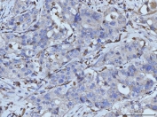 IHC staining of FFPE human appendiceal adenocarcinoma tissue with PLD3 antibody. HIER: boil tissue sections in pH8 EDTA for 20 min and allow to cool before testing.