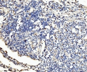 IHC staining of FFPE human liver cancer tissue with PLD3 antibody. HIER: boil tissue sections in pH8 EDTA for 20 min and allow to cool before testing.