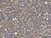 IHC staining of FFPE human liver cancer tissue with PPP2R1A antibody. HIER: boil tissue sections in pH8 EDTA for 20 min and allow to cool before testing.