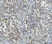IHC staining of FFPE human lung cancer tissue with PPP2R1A antibody. HIER: boil tissue sections in pH8 EDTA for 20 min and allow to cool before testing.