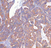 IHC staining of FFPE human ovarian cancer tissue with Prostaglandin E synthase 2 antibody. HIER: boil tissue sections in pH8 EDTA for 20 min and allow to cool before testing.