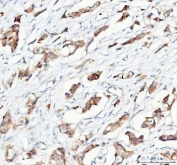 IHC staining of FFPE human breast cancer tissue with Prostaglandin E synthase 2 antibody. HIER: boil tissue sections in pH8 EDTA for 20 min and allow to cool before testing.