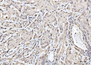IHC staining of FFPE human gall bladder adenosquamous carcinoma tissue with RAE1 antibody. HIER: boil tissue sections in pH8 EDTA for 20 min and allow to cool before testing.