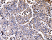 IHC staining of FFPE human liver cancer tissue with RAE1 antibody. HIER: boil tissue sections in pH8 EDTA for 20 min and allow to cool before testing.