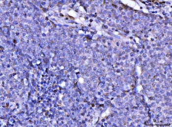 IHC staining of FFPE human lung cancer tissue with RAE1 antibody. HIER: boil tissue sections in pH8 EDTA for 20 min and allow to cool before testing.