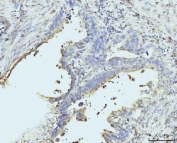 IHC staining of FFPE human appendiceal adenocarcinoma tissue with RPL23 antibody. HIER: boil tissue sections in pH8 EDTA for 20 min and allow to cool before testing.