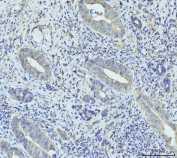 IHC staining of FFPE human gall bladder adenosquamous carcinoma tissue with RPL23 antibody. HIER: boil tissue sections in pH8 EDTA for 20 min and allow to cool before testing.