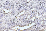 IHC staining of FFPE human appendiceal adenocarcinoma tissue with RPL29 antibody. HIER: boil tissue sections in pH8 EDTA for 20 min and allow to cool before testing.