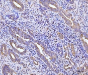 IHC staining of FFPE human gall bladder adenosquamous carcinoma tissue with RPL29 antibody. HIER: boil tissue sections in pH8 EDTA for 20 min and allow to cool before testing.