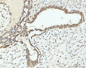 IHC staining of FFPE human breast cancer tissue with RPL29 antibody. HIER: boil tissue sections in pH8 EDTA for 20 min and allow to cool before testing.