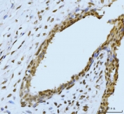 IHC staining of FFPE human breast cancer tissue with SBNO1 antibody. HIER: boil tissue sections in pH8 EDTA for 20 min and allow to cool before testing.