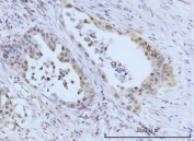 IHC staining of FFPE human appendiceal adenocarcinoma tissue with SBNO1 antibody. HIER: boil tissue sections in pH8 EDTA for 20 min and allow to cool before testing.