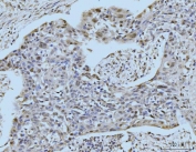 IHC staining of FFPE human esophageal squamous carcinoma tissue with SBNO1 antibody. HIER: boil tissue sections in pH8 EDTA for 20 min and allow to cool before testing.