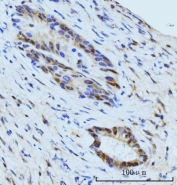 IHC staining of FFPE human gall bladder adenosquamous carcinoma tissue with SBNO1 antibody. HIER: boil tissue sections in pH8 EDTA for 20 min and allow to cool before testing.